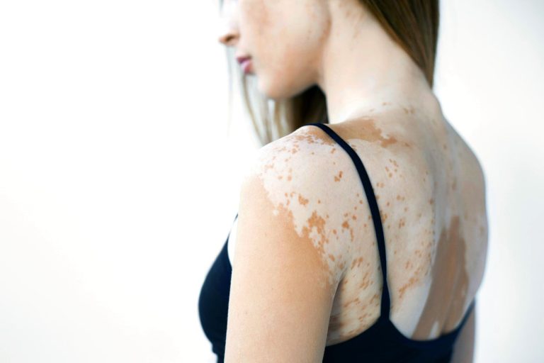 Jeune femme de dos atteinte de vitiligo
